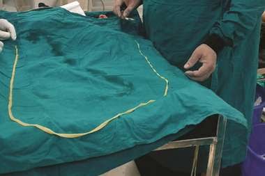 You are currently viewing OMG: मरीज की आंत से निकाला गया 6.3 फुट लंबा जिंदा कीड़ा, जानियें क्या खाने से बनता है ये कीड़ा, वीडियो देखें