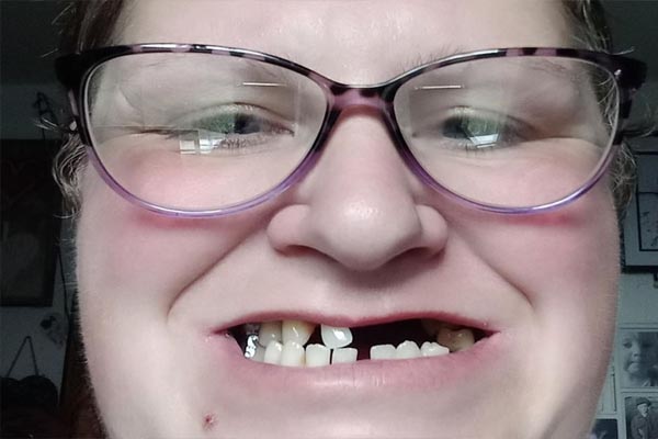 You are currently viewing OMG! डेंटिस्ट के पास जाने की बजाए महिला ने खुद ही उखाड़ डाले 11 दांत, दर्द से है बुरा हाल- जानें इसके पीछे का कारण