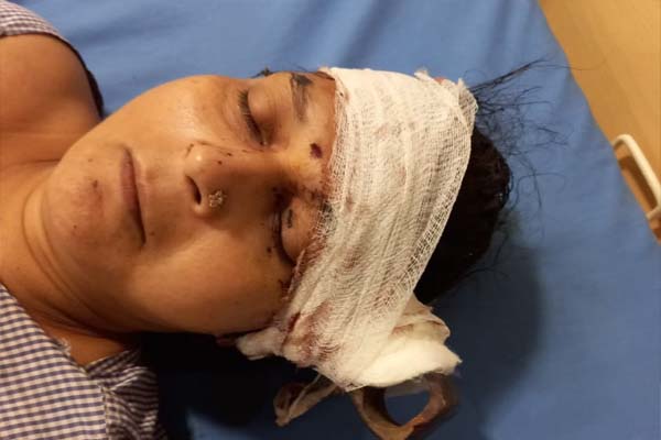 You are currently viewing इस महिला पर हमला कर बदमाशों ने सिर में धंसा दी कुल्हाड़ी, 4 घंटे के ऑपरेशन के बाद डॉक्टरों ने बचाई जान